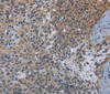 Immunohistochemistry of paraffin-embedded Human cervical cancer using CDC16 Polyclonal Antibody at dilution of 1:50