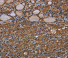 Immunohistochemistry of paraffin-embedded Human thyroid cancer using GJB4 Polyclonal Antibody at dilution of 1:40