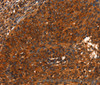 Immunohistochemistry of paraffin-embedded Human cervical cancer using PRKD1 Polyclonal Antibody at dilution of 1:40