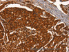 Immunohistochemistry of paraffin-embedded Human breast cancer using PRKD1 Polyclonal Antibody at dilution of 1:40
