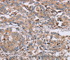 Immunohistochemistry of paraffin-embedded Human liver cancer using MAGEA3 Polyclonal Antibody at dilution of 1:50