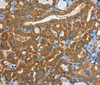 Immunohistochemistry of paraffin-embedded Human thyroid cancer tissue using EPHB3 Polyclonal Antibody at dilution 1:40
