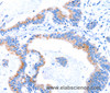 Immunohistochemistry of paraffin-embedded Human colon cancer tissue using SMG8 Polyclonal Antibody at dilution 1:50