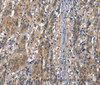 Immunohistochemistry of paraffin-embedded Human gastric cancer tissue using VE-Cadherin Polyclonal Antibody at dilution 1:50