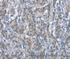 Immunohistochemistry of paraffin-embedded Human gastric cancer tissue using CD226 Polyclonal Antibody at dilution 1:60