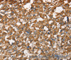 Immunohistochemistry of paraffin-embedded Human thyroid cancer tissue using CDC25A Polyclonal Antibody at dilution 1:60