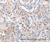 Immunohistochemistry of paraffin-embedded Human liver cancer tissue using MUC2 Polyclonal Antibody at dilution 1:60