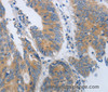 Immunohistochemistry of paraffin-embedded Human colon cancer using CD10 Polyclonal Antibody at dilution of 1:45