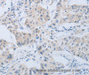 Immunohistochemistry of paraffin-embedded Human lung cancer using CD10 Polyclonal Antibody at dilution of 1:45