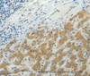 Immunohistochemistry of paraffin-embedded Human liver cancer using NDRG2 Polyclonal Antibody at dilution of 1:50