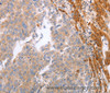 Immunohistochemistry of paraffin-embedded Human ovarian cancer tissue using NRTN Polyclonal Antibody at dilution 1:60