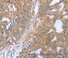 Immunohistochemistry of paraffin-embedded Human breast cancer tissue using NRTN Polyclonal Antibody at dilution 1:60