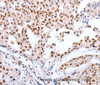 Immunohistochemistry of paraffin-embedded Human lung cancer tissue using Oct-6 Polyclonal Antibody at dilution 1:40