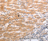 Immunohistochemistry of paraffin-embedded Human liver cancer tissue using HCRTR1 Polyclonal Antibody at dilution 1:70