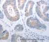 Immunohistochemistry of paraffin-embedded Human colon cancer using PAK1 Polyclonal Antibody at dilution of 1:40