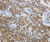 Immunohistochemistry of paraffin-embedded Human lung cancer tissue using PDCD7 Polyclonal Antibody at dilution 1:60