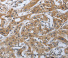 Immunohistochemistry of paraffin-embedded Human lung cancer tissue using PD-1/CD279 Polyclonal Antibody at dilution 1:50