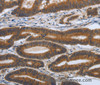 Immunohistochemistry of paraffin-embedded Human colon cancer tissue using PDGFA Polyclonal Antibody at dilution 1:70