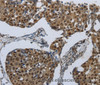 Immunohistochemistry of paraffin-embedded Human breast cancer using PRKAR1B Polyclonal Antibody at dilution of 1:70