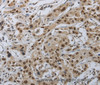 Immunohistochemistry of paraffin-embedded Human lung cancer using PRKAR1B Polyclonal Antibody at dilution of 1:70