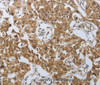 Immunohistochemistry of paraffin-embedded Human lung cancer using PSMD6 Polyclonal Antibody at dilution of 1:40