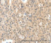 Immunohistochemistry of paraffin-embedded Human ovarian cancer tissue using ROS1 Polyclonal Antibody at dilution 1:40