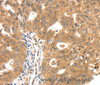 Immunohistochemistry of paraffin-embedded Human ovarian cancer tissue using SCN5A Polyclonal Antibody at dilution 1:30