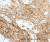 Immunohistochemistry of paraffin-embedded Human esophagus cancer tissue using SCN10A Polyclonal Antibody at dilution 1:25