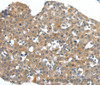 Immunohistochemistry of paraffin-embedded Human esophagus cancer tissue using SCN11A Polyclonal Antibody at dilution 1:40