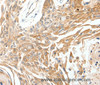 Immunohistochemistry of paraffin-embedded Human breast cancer tissue using SCN11A Polyclonal Antibody at dilution 1:40