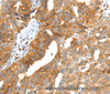 Immunohistochemistry of paraffin-embedded Human ovarian cancer tissue using SCT Polyclonal Antibody at dilution 1:40