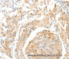 Immunohistochemistry of paraffin-embedded Human cervical cancer tissue using SEMA3D Polyclonal Antibody at dilution 1:50