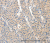 Immunohistochemistry of paraffin-embedded Human liver cancer tissue using SLC20A1 Polyclonal Antibody at dilution 1:40