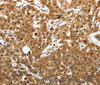 Immunohistochemistry of paraffin-embedded Human lung cancer using SOX-13 Polyclonal Antibody at dilution of 1:50