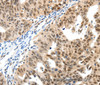 Immunohistochemistry of paraffin-embedded Human ovarian cancer tissue using SP1 Polyclonal Antibody at dilution 1:40