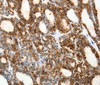 Immunohistochemistry of paraffin-embedded Human thyroid cancer tissue using SSTR1 Polyclonal Antibody at dilution 1:50