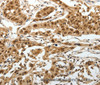 Immunohistochemistry of paraffin-embedded Human lung cancer tissue using SUMO1 Polyclonal Antibody at dilution 1:30