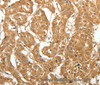 Immunohistochemistry of paraffin-embedded Human lung cancer tissue using MAP1B  Polyclonal Antibody at dilution 1:60