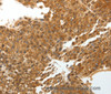 Immunohistochemistry of paraffin-embedded Human liver cancer tissue using TNXB Polyclonal Antibody at dilution 1:40