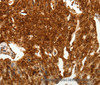 Immunohistochemistry of paraffin-embedded Human lung cancer tissue using TENM3 Polyclonal Antibody at dilution 1:50