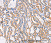 Immunohistochemistry of paraffin-embedded Human thyroid cancer tissue using Factor XIIIa Polyclonal Antibody at dilution 1:80