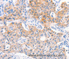 Immunohistochemistry of paraffin-embedded Human lung cancer tissue using Factor XIIIa Polyclonal Antibody at dilution 1:80