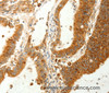 Immunohistochemistry of paraffin-embedded Human colon cancer using RARRES1 Polyclonal Antibody at dilution of 1:60