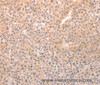 Immunohistochemistry of paraffin-embedded Human liver cancer tissue using TRPC3 Polyclonal Antibody at dilution 1:50