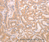 Immunohistochemistry of paraffin-embedded Human thyroid cancer tissue using TRPC3 Polyclonal Antibody at dilution 1:50