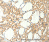 Immunohistochemistry of paraffin-embedded Human thyroid cancer using TRPM5 Polyclonal Antibody at dilution of 1:60