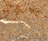 Immunohistochemistry of paraffin-embedded Human liver cancer tissue using TRPM7 Polyclonal Antibody at dilution 1:30