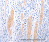 Immunohistochemistry of paraffin-embedded Human gasrtic cancer tissue using LPAR2 Polyclonal Antibody at dilution 1:40