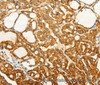 Immunohistochemistry of paraffin-embedded Human thyroid cancer tissue using FZD6 Polyclonal Antibody at dilution 1:60