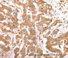 Immunohistochemistry of paraffin-embedded Human colon cancer tissue using CELSR2 Polyclonal Antibody at dilution 1:50